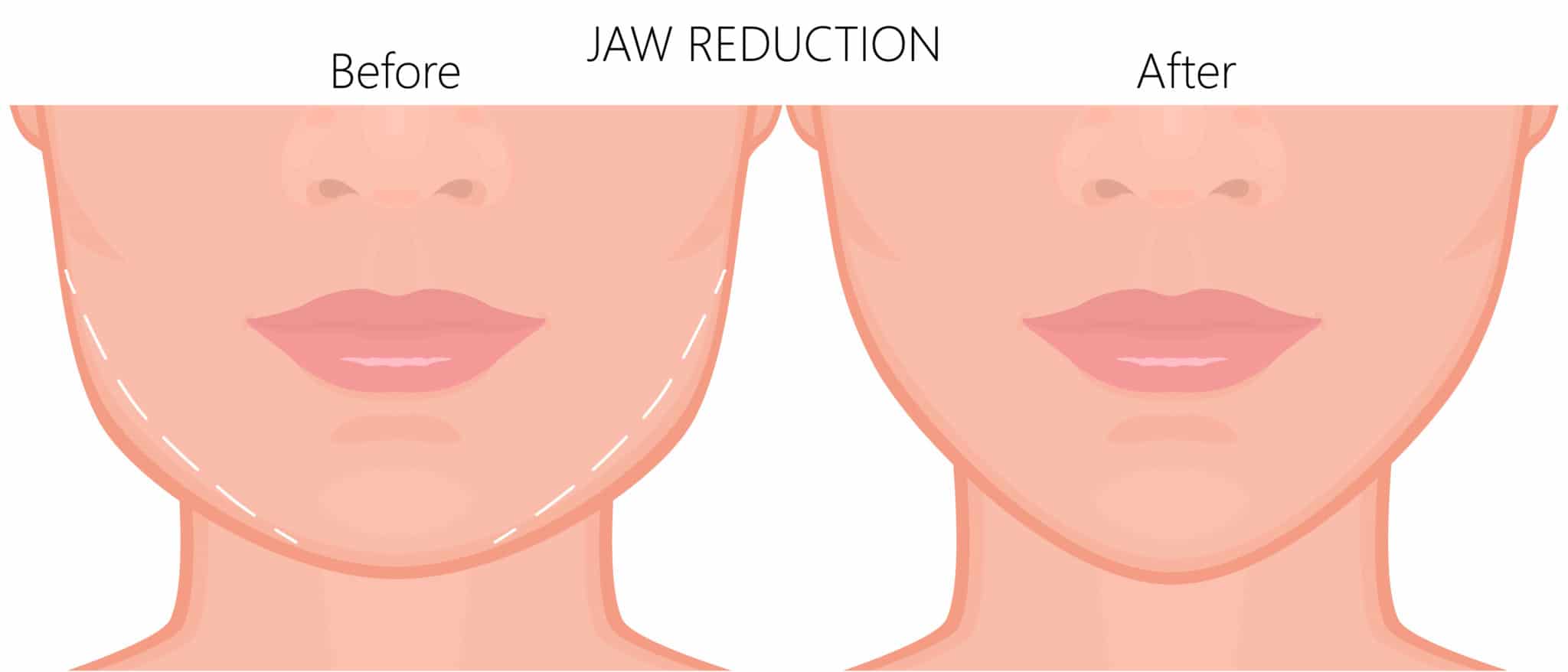 Occlusal equilibration can help balance teeth to treat tmj disorder